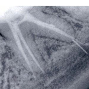 tooth x-ray